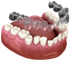 Antakya Invisalign telsiz ortodontik tedavi